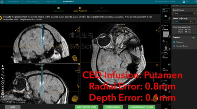 intraoperative MRI (iMRI) navigation system for NHPs, combined with convection-enhanced delivery (CED), Prisys Biotech has built a state-of-the-art CNS drug delivery platform. intraoperative MRI (iMRI) navigation system for NHPs, combined with convection-enhanced delivery (CED), Prisys Biotech has built a state-of-the-art CNS drug delivery platform.